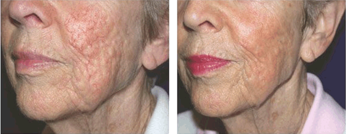 Voor en na het verwijderen van pigmentvlekken in het gelaat Voor en na het verwijderen van pigmentvlekken in het gelaat