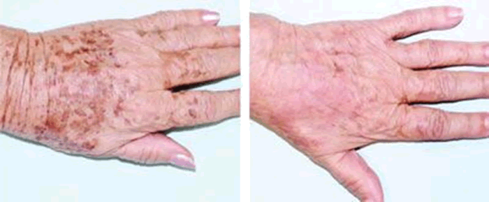 Voor en na het verwijderen van pigmentvlekken op de hand Voor en na het verwijderen van pigmentvlekken op de hand